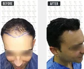 Haartransplantation Vorher-Nachher MerhaBeauty