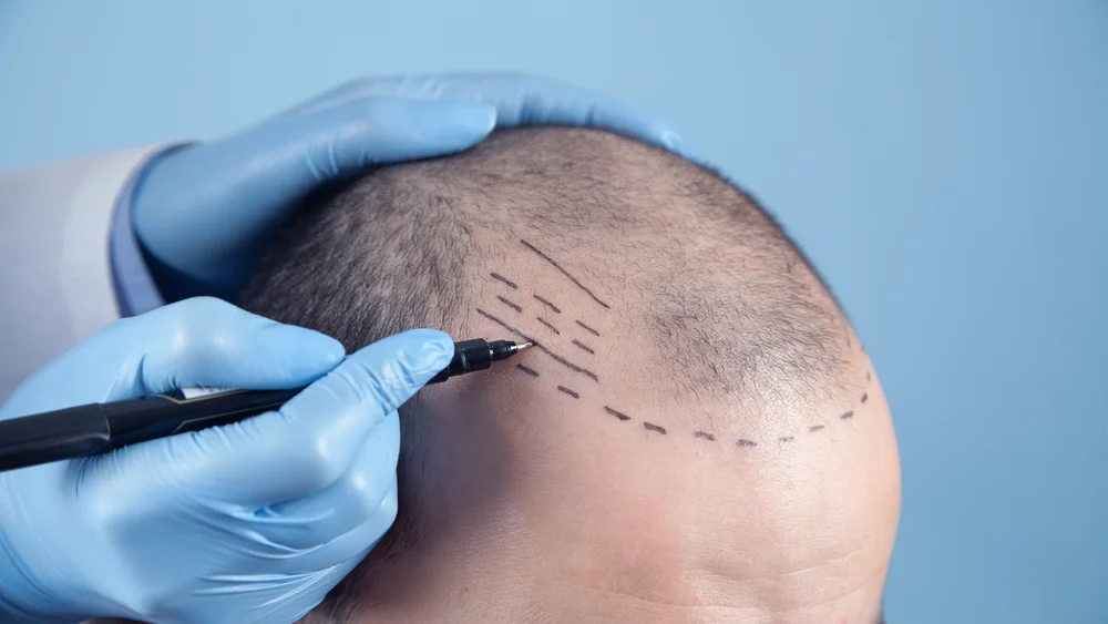 ab 4500 Grafts Geheimratsecken Haartransplantation bei MerhaBeauty
