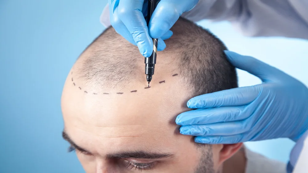 Geheimratsecken Haartransplantation bei MerhaBeauty