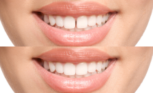 Dental Bonding Merhabeauty