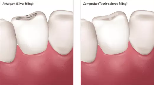 Amalgan - Komposit (Composite) Füllung Merhabeauty