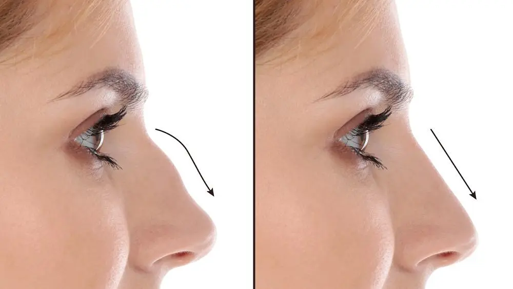 Nasenkorrektur- Rhinoplastik in der Türkei bei Merhabeauty